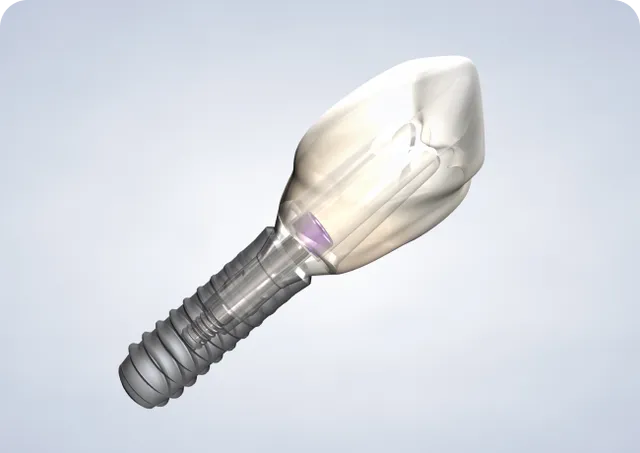 Dental Implants illustration