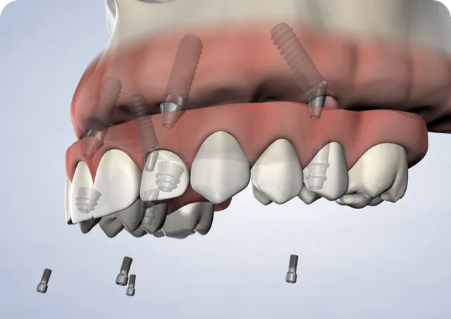 Full-Arch Restoration illustration