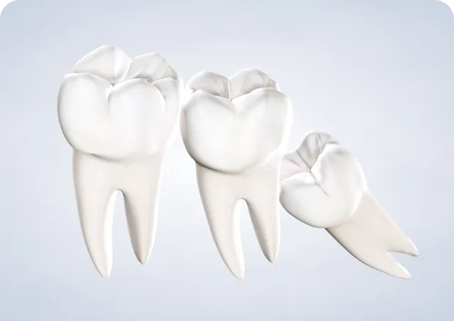 Wisdom Teeth Removal illustration