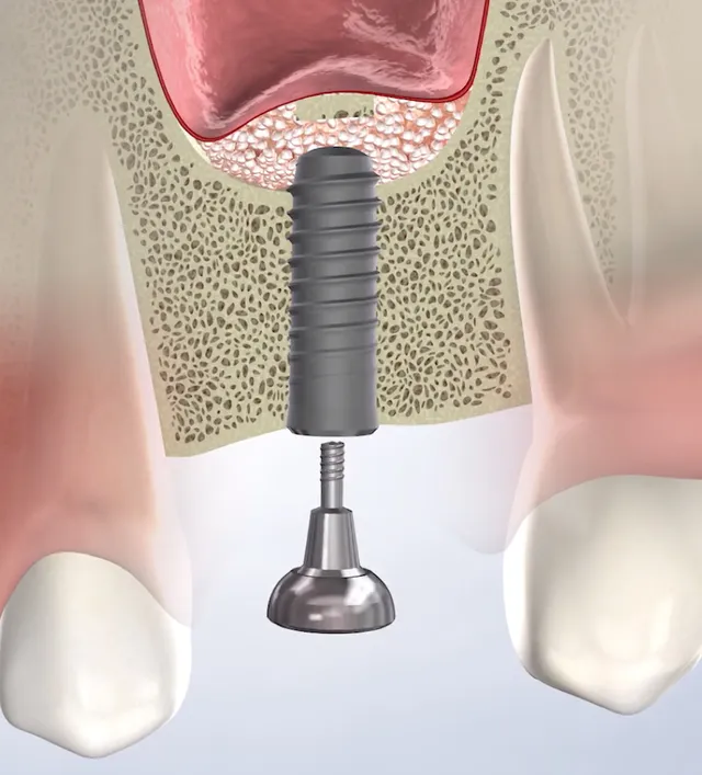Illustration of Bone Grafting