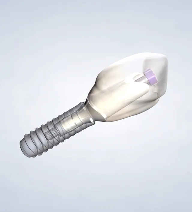 Illustration of Dental Implants