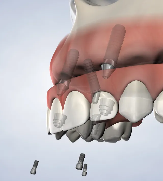 Illustration of All-on-4® Treatment Concept