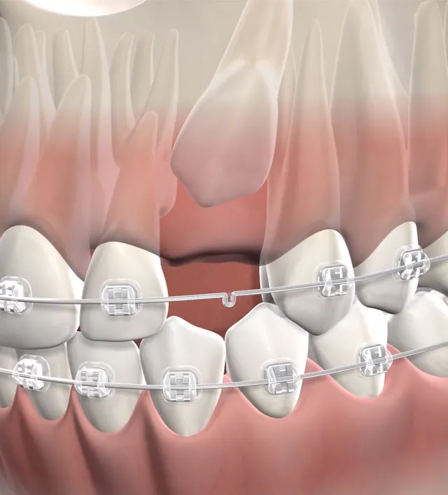 Illustration of Impacted Tooth Exposure