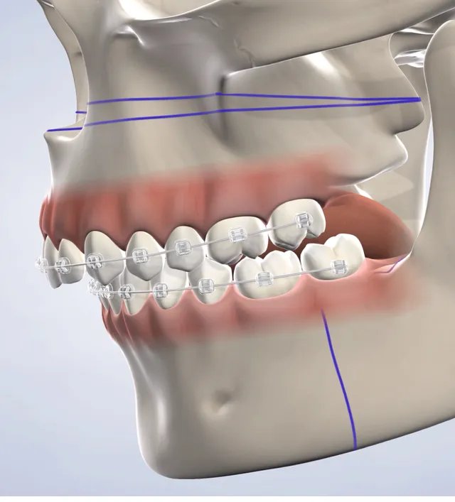 Illustration of Orthognathic Surgery