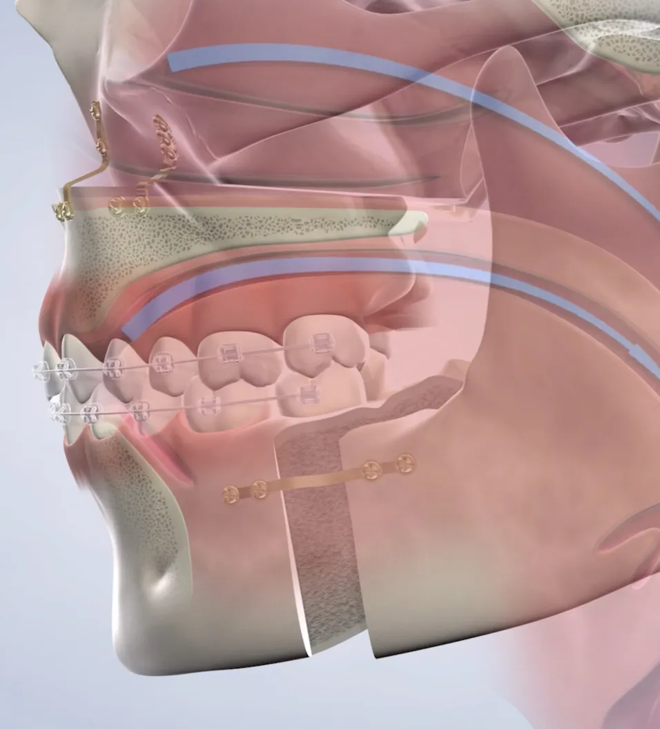 Illustration of Sleep Apnea Treatment