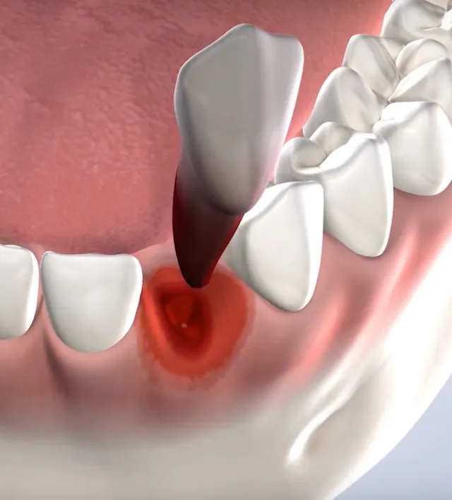 Illustration of Tooth Extractions