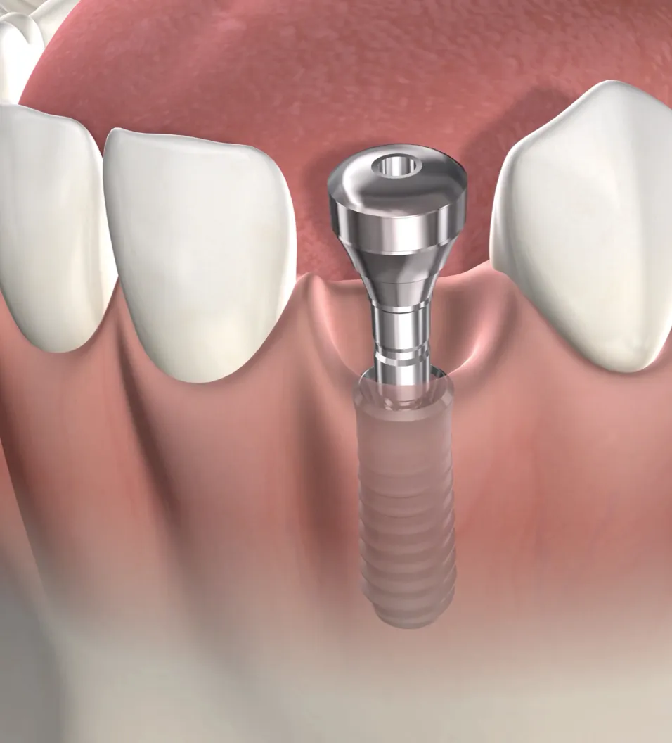 Illustration of Tooth Replacement Options