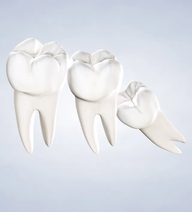 Illustration of Wisdom Teeth Removal
